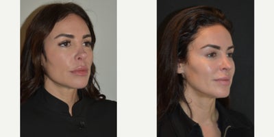 Revision Rhinoplasty before and after photo