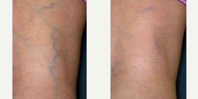 Sclerotherapy before and after photo