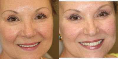 Dental Bonding before and after photo