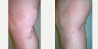 EVLT before and after photo