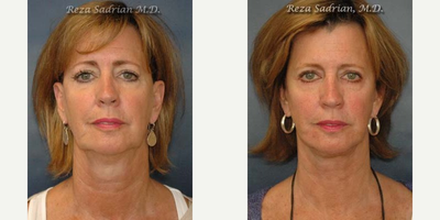 Facelift before and after photo