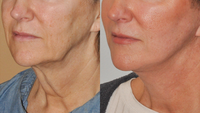 Facelift before and after photo