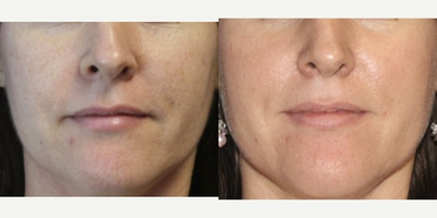 Fraxel Laser before and after photo