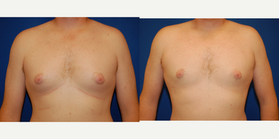 Gynecomastia Surgery before and after photo