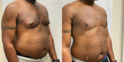 Gynecomastia Surgery before and after photo