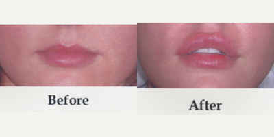 Lip Fillers before and after photo