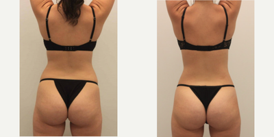 Liposuction before and after photo