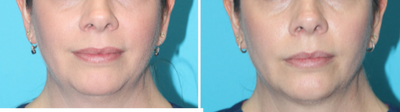 CoolSculpting before and after photo