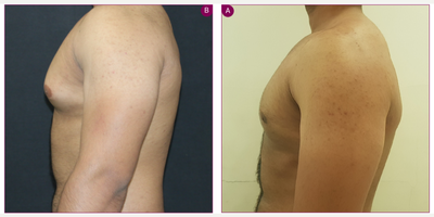 Gynecomastia Surgery before and after photo