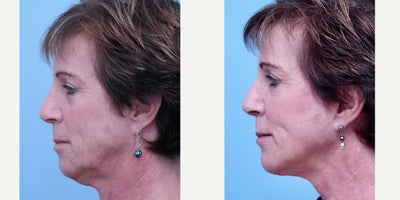 Mini Facelift before and after photo