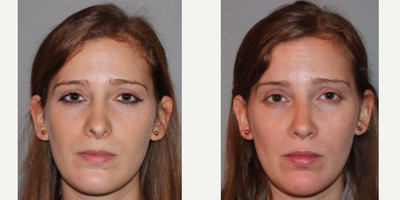 Revision Rhinoplasty before and after photo