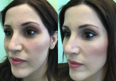 Belotero before and after photo
