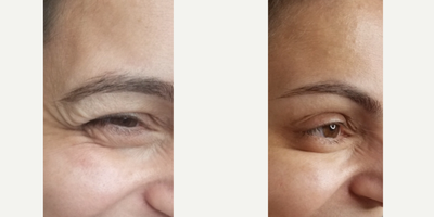Botox before and after photo