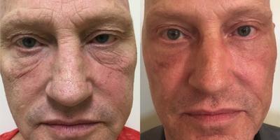 Dermal Fillers before and after photo