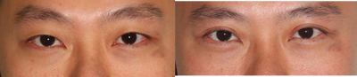 Double Eyelid Surgery before and after photo