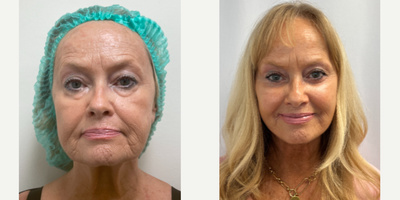 Facelift before and after photo