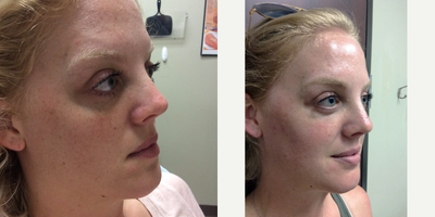 Juvederm before and after photo
