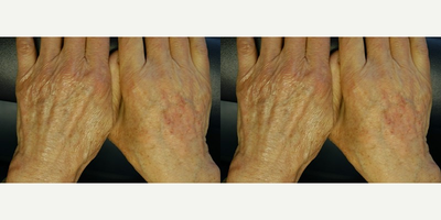 Radiesse before and after photo