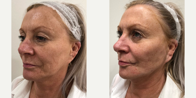 Radiesse before and after photo