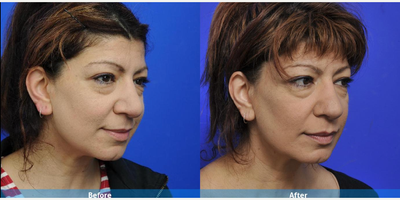 Rhinoplasty before and after photo