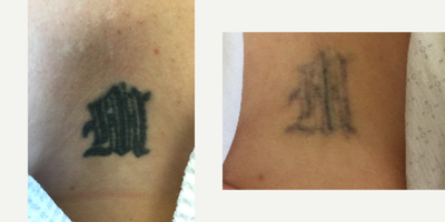 Tattoo Removal before and after photo