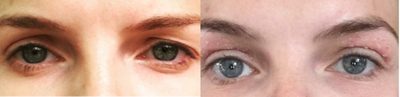 Eyelid Surgery before and after photo