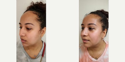 Rhinoplasty before and after photo