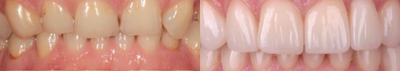 Teeth Whitening before and after photo