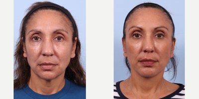 Facial Fat Transfer before and after photo