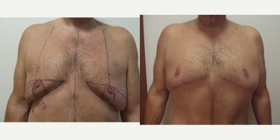 Gynecomastia Surgery before and after photo