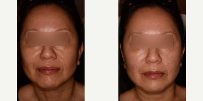 Juvederm before and after photo