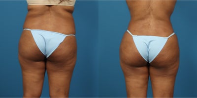 Liposuction before and after photo