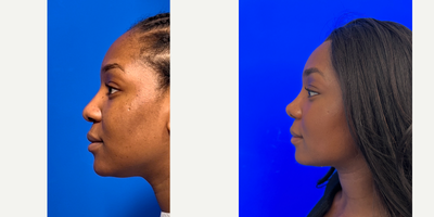 African American Rhinoplasty before and after photo