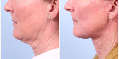 Deep Plane Facelift before and after photo