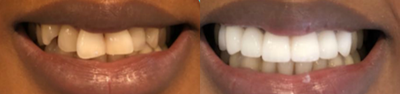 Dental Crown before and after photo