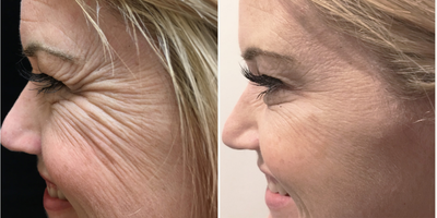 Dysport before and after photo