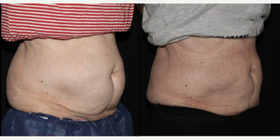 Emsculpt before and after photo