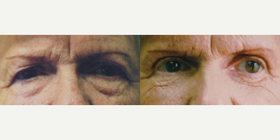 Eyelid Surgery before and after photo