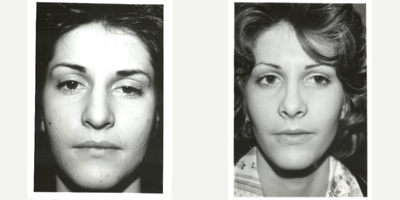 Rhinoplasty before and after photo