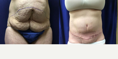Tummy Tuck before and after photo