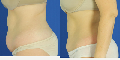 Vanquish before and after photo