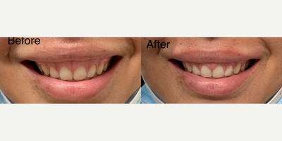 Botox before and after photo