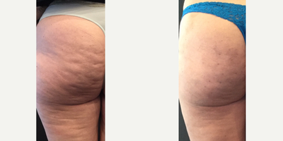 Cellfina before and after photo
