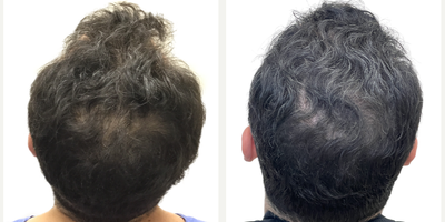 Rogaine before and after photo