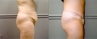Tummy Tuck before and after photo