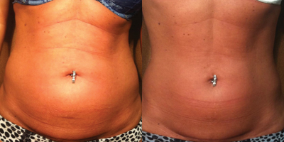 Venus Legacy before and after photo