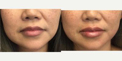 Lip Fillers before and after photo