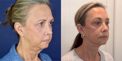 Neck Lift before and after photo