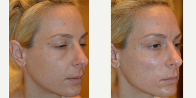 Restylane before and after photo