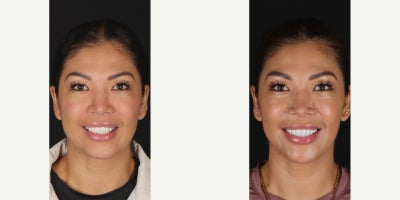 Smile Makeover before and after photo